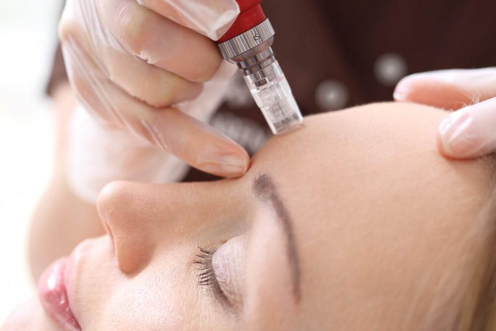 Microneedle mesotherapy of a woman